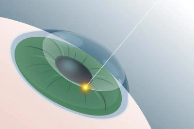 愛爾眼科：經(jīng)常熬夜玩手機(jī)，可以做近視手術(shù)嗎？(圖2)