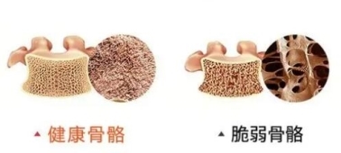 科普氨糖軟骨素鈣片養(yǎng)護(hù)原理及氨糖軟骨素鈣片正確吃法(圖4) 科普氨糖軟骨素鈣片養(yǎng)護(hù)原理及氨糖軟骨素鈣片正確吃法(圖4)