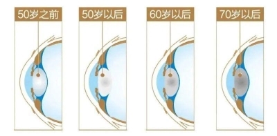 愛爾眼科：白內(nèi)障不會“缺席”只會“遲到”？(圖6)