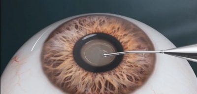 愛爾眼科：白內(nèi)障不會“缺席”只會“遲到”？(圖5)