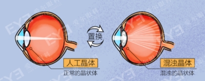 愛爾眼科：白內(nèi)障不會“缺席”只會“遲到”？(圖4)